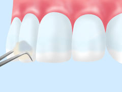 歯周病のメインテナンスに「PMTC」